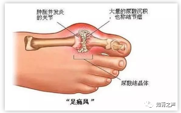 全了！各年龄段血压、血糖、血脂、尿酸对照表，人手一份！(图6)